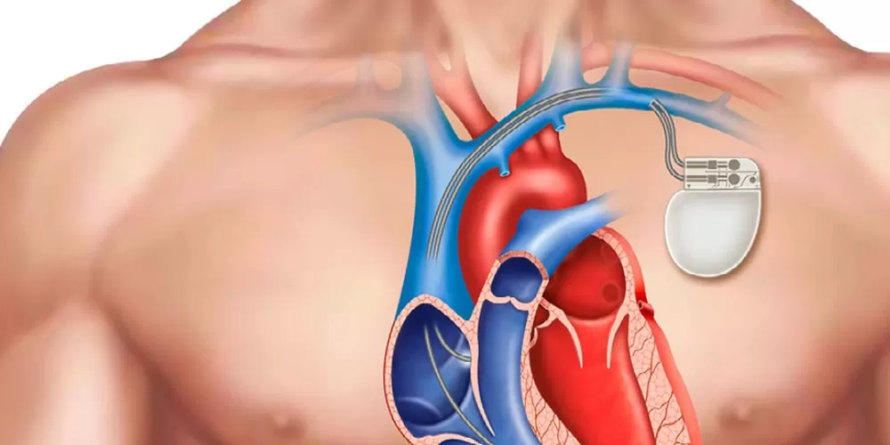 Pacemaker Surgery in Agra