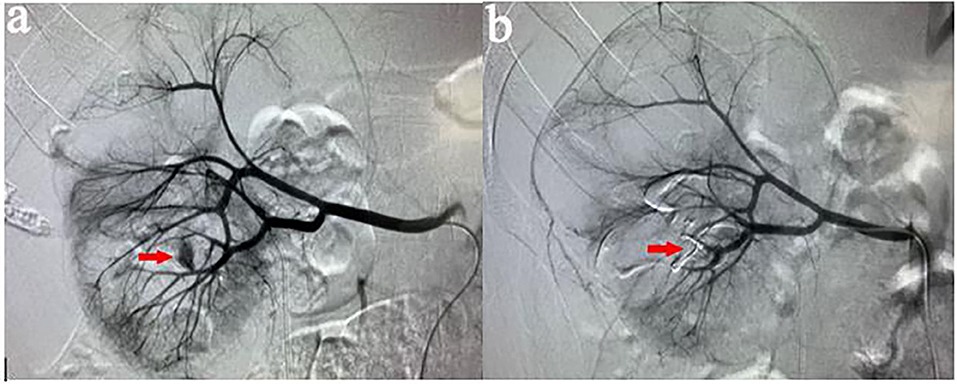 Renal angio-embolization in Agra